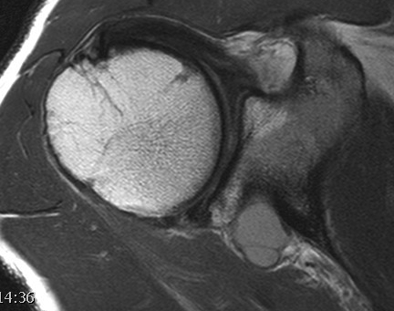 Spinoglenoid Cyst MRI Axial